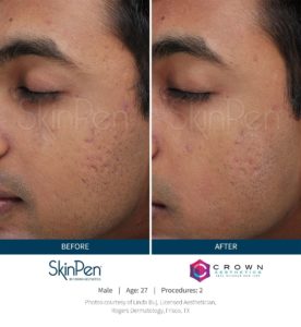 Man face, eye wrinkles before and after treatment - the result of rejuvenating cosmetological procedures of Microneedling | Vita Aesthetics in Sarasota, FL