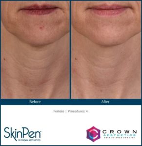 Woman face before and after treatment - the result of rejuvenating cosmetological procedures of Microneedling | Vita Aesthetics in Sarasota, FL