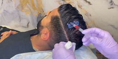 Mesotherapy for male hair. Handsome bearded man receiving injections in his head, having mesotherapy session at beauty salon, therapist in protective glove with syringe, closeup | Vita Aesthetics in Sarasota, FL