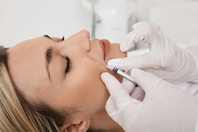 Nasolabial fold filler