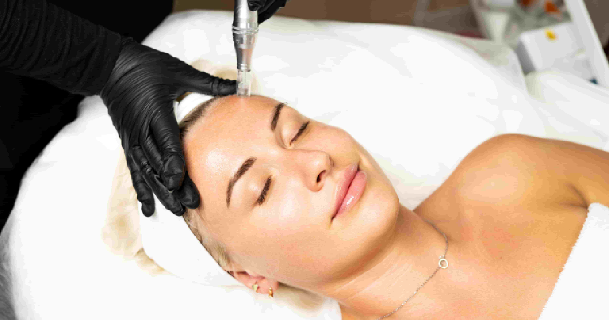 A person in black gloves performs a microneedling treatment on a woman's forehead in Sarasota, Florida.