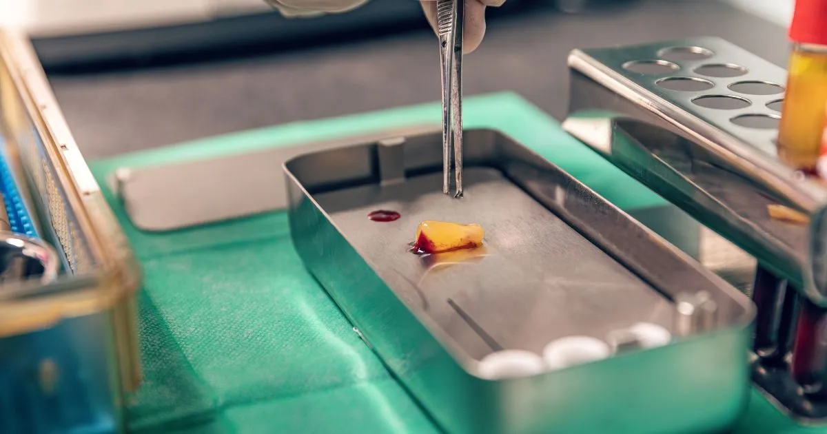 Non-Surgical PRF Treatment in Sarasota FL, showing tissue with blood in a tray