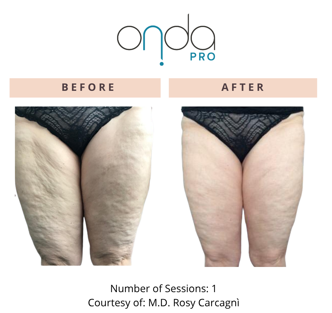 Onda Pro BA 5