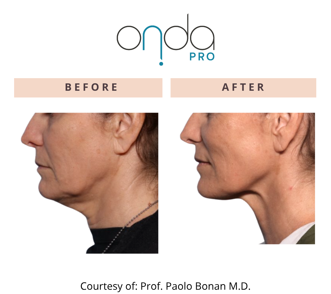 Onda Pro BA2