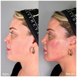 Woman face, eye wrinkles before and after treatment - the result of rejuvenating cosmetological procedures of biorevitalization, botox and pigment spots removal | Vita Aesthetics in Sarasota, FL