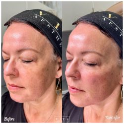 Woman face, eye wrinkles before and after treatment - the result of rejuvenating cosmetological procedures of biorevitalization, botox and pigment spots removal | Vita Aesthetics in Sarasota, FL