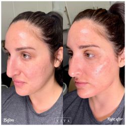 Woman face, eye wrinkles before and after treatment - the result of rejuvenating cosmetological procedures of biorevitalization, botox and pigment spots removal | Vita Aesthetics in Sarasota, FL