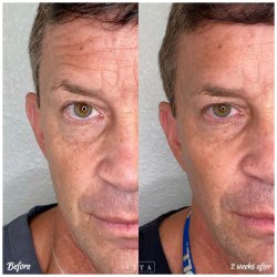 Man face, eye wrinkles before and after treatment - the result of rejuvenating cosmetological procedures of biorevitalization, botox and pigment spots removal | Vita Aesthetics in Sarasota, FL