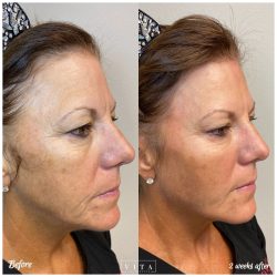 Woman face, eye wrinkles before and after treatment - the result of rejuvenating cosmetological procedures of biorevitalization, botox and pigment spots removal | Vita Aesthetics in Sarasota, FL