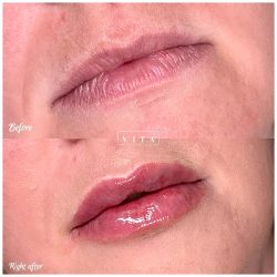 Lips filler injection for beautiful woman lip augmentation with hyaluronic acid at a beauty salon by Vita Aesthetics LLC in Sarasota