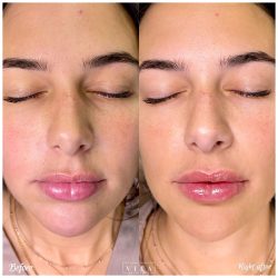 Woman face, eye wrinkles before and after treatment - the result of rejuvenating cosmetological procedures of biorevitalization, botox and pigment spots removal | Vita Aesthetics in Sarasota, FL