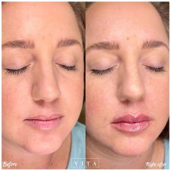 Woman face, eye wrinkles before and after treatment - the result of rejuvenating cosmetological procedures of biorevitalization, botox and pigment spots removal | Vita Aesthetics in Sarasota, FL