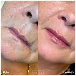 Woman face, eye wrinkles before and after treatment - the result of rejuvenating cosmetological procedures of biorevitalization, botox and pigment spots removal | Vita Aesthetics in Sarasota, FL