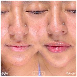 Woman face, eye wrinkles before and after treatment - the result of rejuvenating cosmetological procedures of biorevitalization, botox and pigment spots removal | Vita Aesthetics in Sarasota, FL