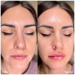 Woman face, eye wrinkles before and after treatment - the result of rejuvenating cosmetological procedures of biorevitalization, botox and pigment spots removal | Vita Aesthetics in Sarasota, FL