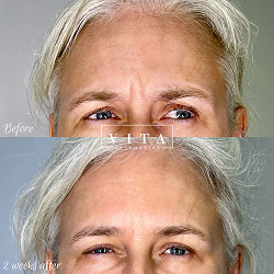 Woman face, eye wrinkles before and after treatment - the result of rejuvenating cosmetological procedures of biorevitalization, botox and pigment spots removal | Vita Aesthetics in Sarasota, FL