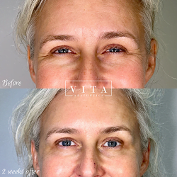 Woman face, eye wrinkles before and after treatment - the result of rejuvenating cosmetological procedures of biorevitalization, botox and pigment spots removal | Vita Aesthetics in Sarasota, FL