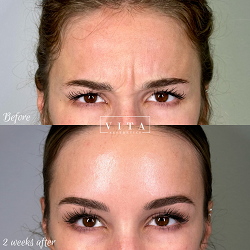 Woman face, eye wrinkles before and after treatment - the result of rejuvenating cosmetological procedures of biorevitalization, botox and pigment spots removal | Vita Aesthetics in Sarasota, FL