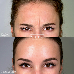 Woman face, eye wrinkles before and after treatment - the result of rejuvenating cosmetological procedures of biorevitalization, botox and pigment spots removal | Vita Aesthetics in Sarasota, FL