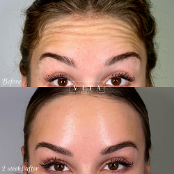 Woman face, eye wrinkles before and after treatment - the result of rejuvenating cosmetological procedures of biorevitalization, botox and pigment spots removal | Vita Aesthetics in Sarasota, FL