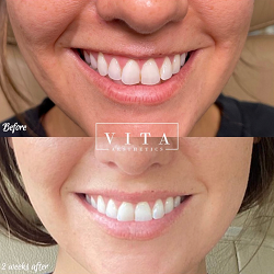 Woman face before and after treatment - the result of rejuvenating cosmetological procedures of biorevitalization, botox and pigment spots removal | Vita Aesthetics in Sarasota, FL