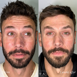 Man face, eye wrinkles before and after treatment - the result of rejuvenating cosmetological procedures of biorevitalization, botox and pigment spots removal | Vita Aesthetics in Sarasota, FL