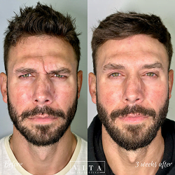 Man face, eye wrinkles before and after treatment - the result of rejuvenating cosmetological procedures of biorevitalization, botox and pigment spots removal | Vita Aesthetics in Sarasota, FL