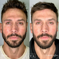 Man face, eye wrinkles before and after treatment - the result of rejuvenating cosmetological procedures of biorevitalization, botox and pigment spots removal | Vita Aesthetics in Sarasota, FL