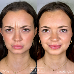 Man face, eye wrinkles before and after treatment - the result of rejuvenating cosmetological procedures of biorevitalization, botox and pigment spots removal | Vita Aesthetics in Sarasota, FL
