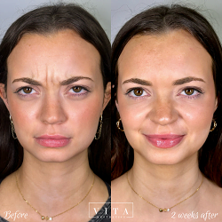 Women face, eye wrinkles before and after treatment - the result of rejuvenating cosmetological procedures of biorevitalization, botox and pigment spots removal | Vita Aesthetics in Sarasota, FL