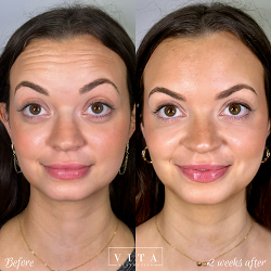 Women face, eye wrinkles before and after treatment - the result of rejuvenating cosmetological procedures of biorevitalization, botox and pigment spots removal | Vita Aesthetics in Sarasota, FL