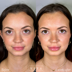 Women face, eye wrinkles before and after treatment - the result of rejuvenating cosmetological procedures of biorevitalization, botox and pigment spots removal | Vita Aesthetics in Sarasota, FL