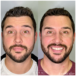 Man face, eye wrinkles before and after treatment - the result of rejuvenating cosmetological procedures of biorevitalization, botox and pigment spots removal | Vita Aesthetics in Sarasota, FL