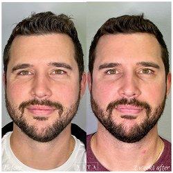 Man face, eye wrinkles before and after treatment - the result of rejuvenating cosmetological procedures of biorevitalization, botox and pigment spots removal | Vita Aesthetics in Sarasota, FL