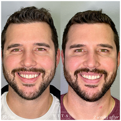 Man face, eye wrinkles before and after treatment - the result of rejuvenating cosmetological procedures of biorevitalization, botox and pigment spots removal | Vita Aesthetics in Sarasota, FL