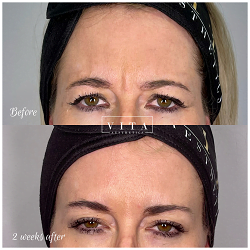 Woman face, eye wrinkles before and after treatment - the result of rejuvenating cosmetological procedures of biorevitalization, botox and pigment spots removal | Vita Aesthetics in Sarasota, FL