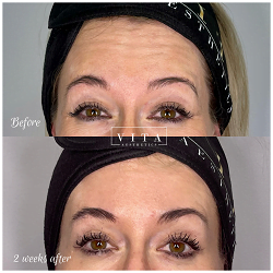 Woman face, eye wrinkles before and after treatment - the result of rejuvenating cosmetological procedures of biorevitalization, botox and pigment spots removal | Vita Aesthetics in Sarasota, FL