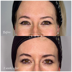 Woman face, eye wrinkles before and after treatment - the result of rejuvenating cosmetological procedures of biorevitalization, botox and pigment spots removal | Vita Aesthetics in Sarasota, FL