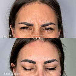 Woman face, eye wrinkles before and after treatment - the result of rejuvenating cosmetological procedures of biorevitalization, botox and pigment spots removal | Vita Aesthetics in Sarasota, FL