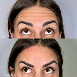 Woman face, eye wrinkles before and after treatment - the result of rejuvenating cosmetological procedures of biorevitalization, botox and pigment spots removal | Vita Aesthetics in Sarasota, FL