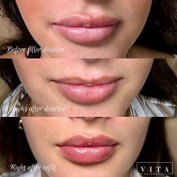 Lips filler injection for beautiful woman lip augmentation with hyaluronic acid at a beauty salon by Vita Aesthetics LLC in Sarasota