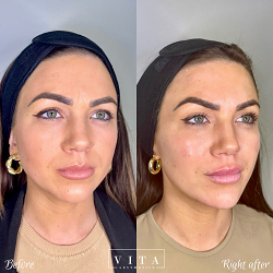 Woman face, eye wrinkles before and after treatment - the result of rejuvenating cosmetological procedures of biorevitalization, botox and pigment spots removal | Vita Aesthetics in Sarasota, FL