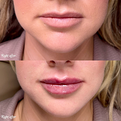 Lips filler injection for beautiful woman lip augmentation with hyaluronic acid at a beauty salon