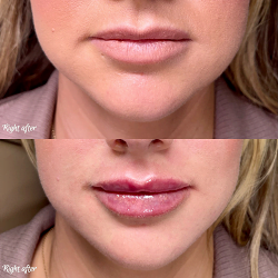 Lips filler injection for beautiful woman lip augmentation with hyaluronic acid at a beauty salon by Vita Aesthetics LLC in Sarasota