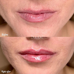 Lips filler injection for beautiful woman lip augmentation with hyaluronic acid at a beauty salon by Vita Aesthetics LLC in Sarasota