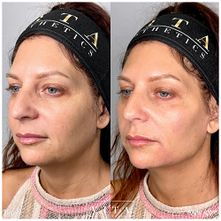 Woman face, eye wrinkles before and after treatment - the result of rejuvenating cosmetological procedures of biorevitalization, botox and pigment spots removal | Vita Aesthetics in Sarasota, FL