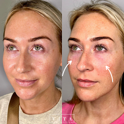 Woman face, eye wrinkles before and after treatment - the result of rejuvenating cosmetological procedures of biorevitalization, botox and pigment spots removal | Vita Aesthetics in Sarasota, FL