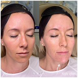 Woman face, eye wrinkles before and after treatment - the result of rejuvenating cosmetological procedures of biorevitalization, botox and pigment spots removal | Vita Aesthetics in Sarasota, FL