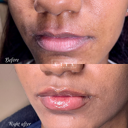 Lips filler injection for beautiful woman lip augmentation with hyaluronic acid at a beauty salon | Vita Aesthetics in Sarasota, FL