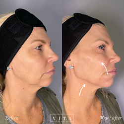 Woman face, eye wrinkles before and after treatment - the result of rejuvenating cosmetological procedures of biorevitalization, botox and pigment spots removal | Vita Aesthetics in Sarasota, FL